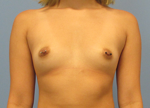 Breast Augmentation Before and After | SGK Plastic Surgery