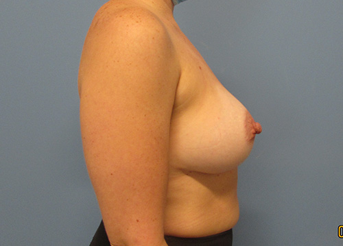 Breast Augmentation Before and After | SGK Plastic Surgery