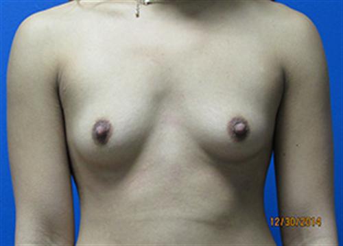 Breast Augmentation Before and After | SGK Plastic Surgery