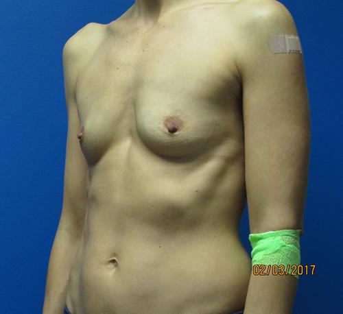 Breast Augmentation Before and After | SGK Plastic Surgery