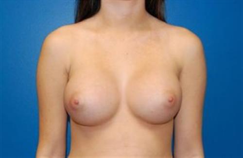 Breast Augmentation Before and After | SGK Plastic Surgery