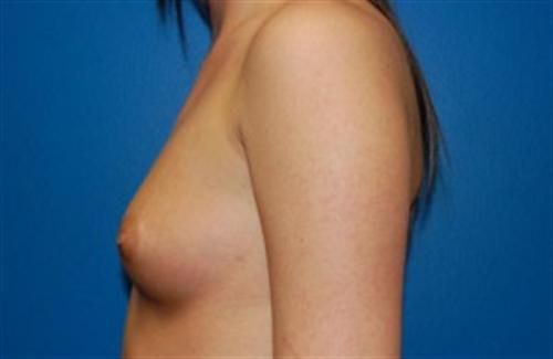 Breast Augmentation Before and After | SGK Plastic Surgery