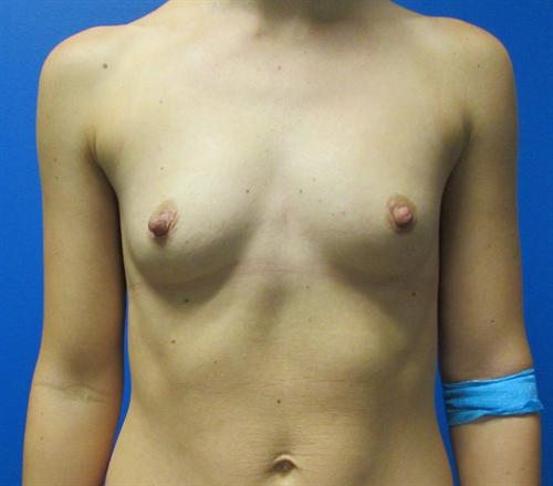 Breast Augmentation Before and After | SGK Plastic Surgery