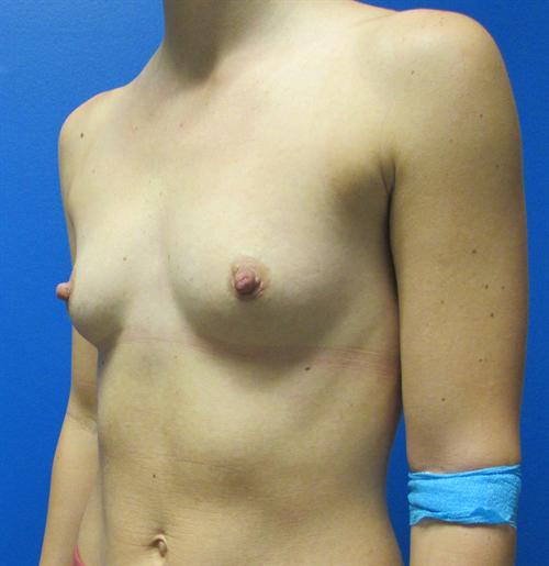 Breast Augmentation Before and After | SGK Plastic Surgery