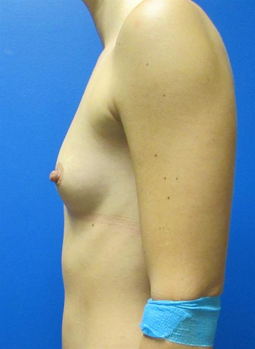 Breast Augmentation Before and After | SGK Plastic Surgery