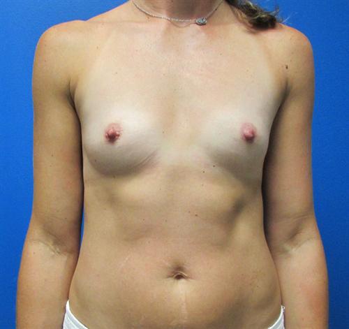 Breast Augmentation Before and After | SGK Plastic Surgery