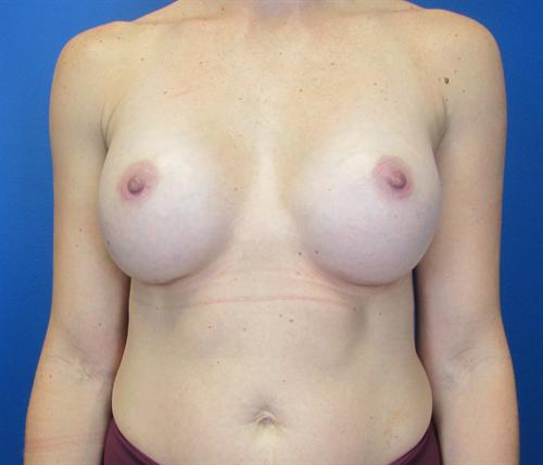 Breast Augmentation Before and After | SGK Plastic Surgery