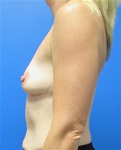 Breast Augmentation Before and After | SGK Plastic Surgery