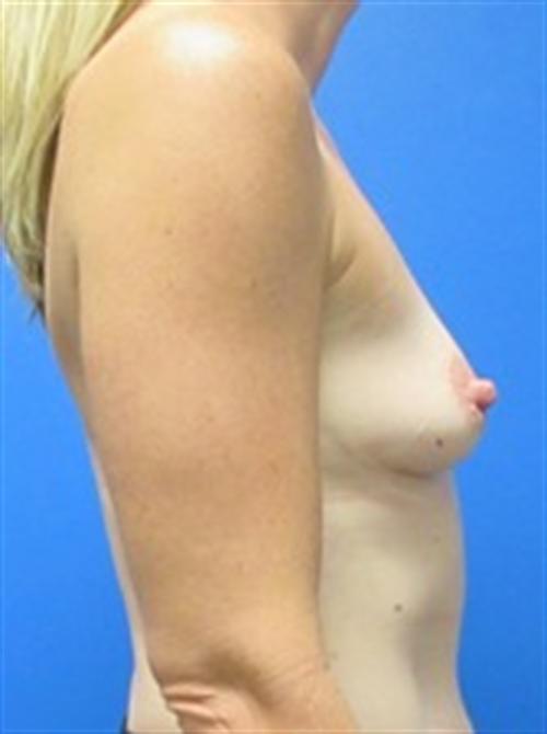 Breast Augmentation Before and After | SGK Plastic Surgery