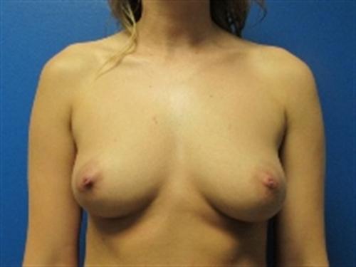 Breast Augmentation Before and After | SGK Plastic Surgery