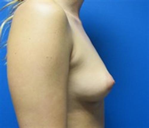 Breast Augmentation Before and After | SGK Plastic Surgery