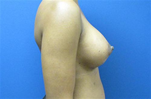 Breast Augmentation Before and After | SGK Plastic Surgery