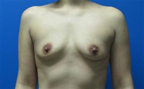 Breast Augmentation Before and After | SGK Plastic Surgery