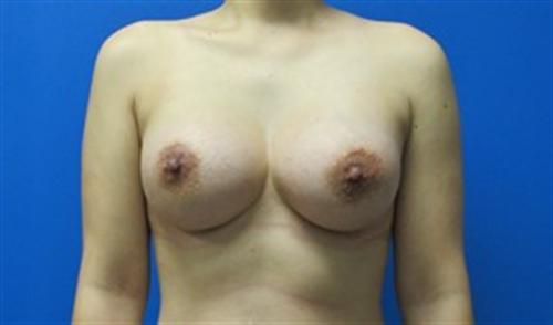 Breast Augmentation Before and After | SGK Plastic Surgery