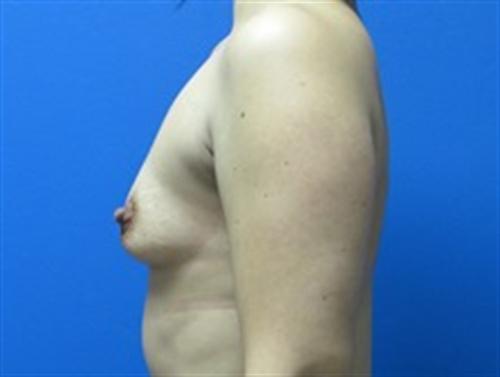 Breast Augmentation Before and After | SGK Plastic Surgery