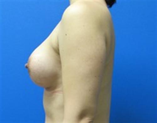 Breast Augmentation Before and After | SGK Plastic Surgery