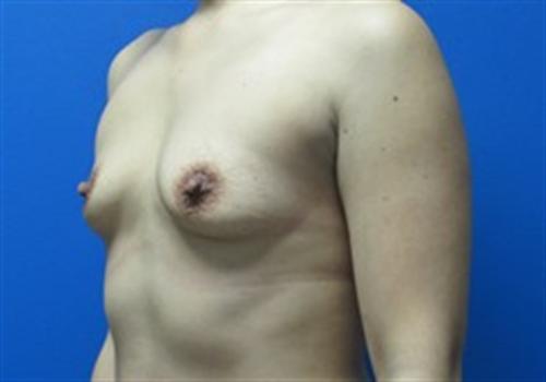 Breast Augmentation Before and After | SGK Plastic Surgery