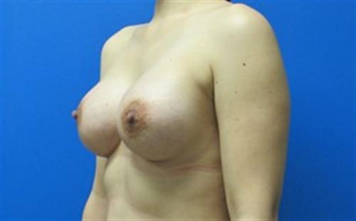 Breast Augmentation Before and After | SGK Plastic Surgery