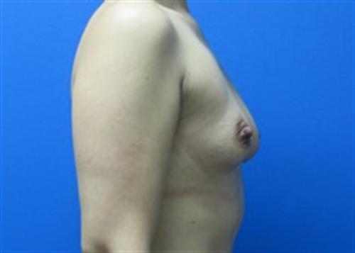 Breast Augmentation Before and After | SGK Plastic Surgery