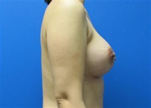 Breast Augmentation Before and After | SGK Plastic Surgery