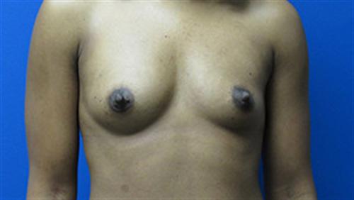 Breast Augmentation Before and After | SGK Plastic Surgery