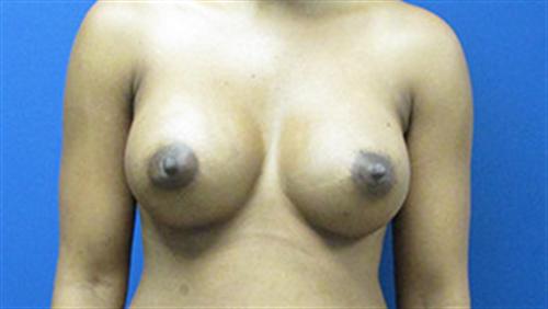 Breast Augmentation Before and After | SGK Plastic Surgery