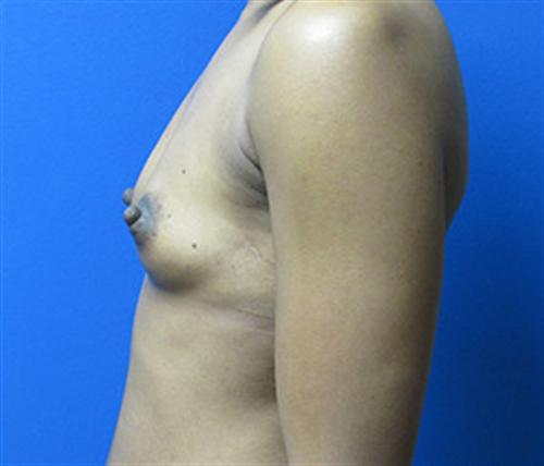 Breast Augmentation Before and After | SGK Plastic Surgery