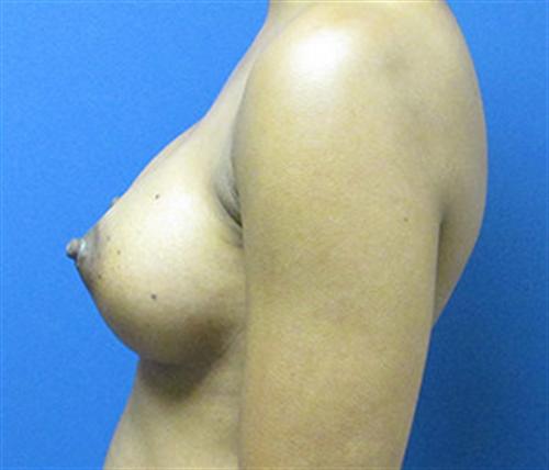 Breast Augmentation Before and After | SGK Plastic Surgery