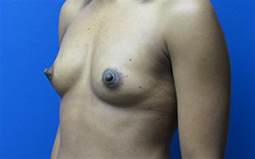 Breast Augmentation Before and After | SGK Plastic Surgery