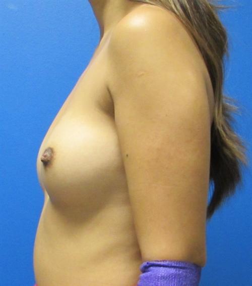 Breast Augmentation Before and After | SGK Plastic Surgery