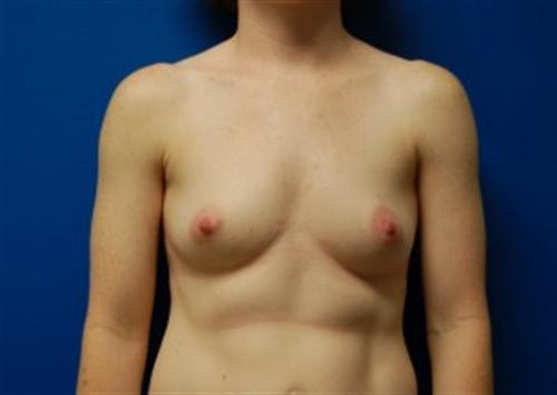 Breast Augmentation Before and After | SGK Plastic Surgery