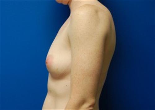 Breast Augmentation Before and After | SGK Plastic Surgery