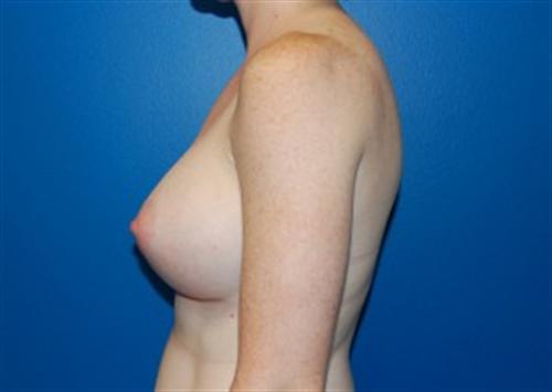 Breast Augmentation Before and After | SGK Plastic Surgery