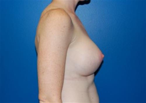 Breast Augmentation Before and After | SGK Plastic Surgery