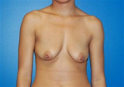 Breast Augmentation Before and After | SGK Plastic Surgery