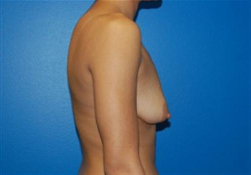 Breast Augmentation Before and After | SGK Plastic Surgery