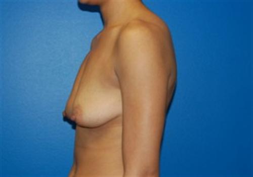 Breast Augmentation Before and After | SGK Plastic Surgery