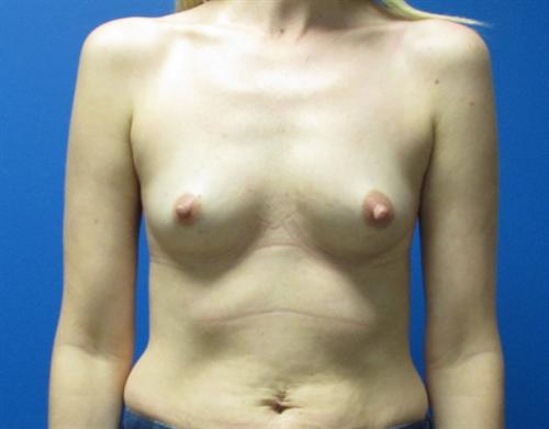 Breast Augmentation Before and After | SGK Plastic Surgery