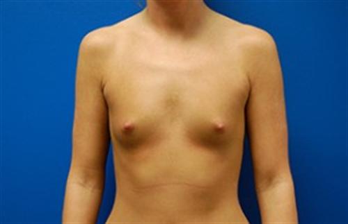 Breast Augmentation Before and After | SGK Plastic Surgery