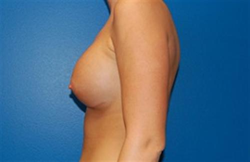 Breast Augmentation Before and After | SGK Plastic Surgery