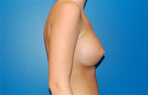 Breast Augmentation Before and After | SGK Plastic Surgery