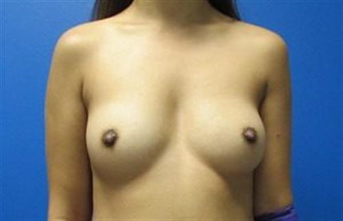 Breast Augmentation Before and After | SGK Plastic Surgery