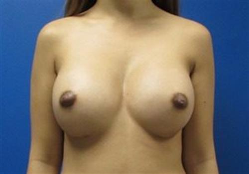 Breast Augmentation Before and After | SGK Plastic Surgery