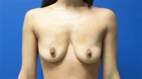 Breast Augmentation Before and After | SGK Plastic Surgery