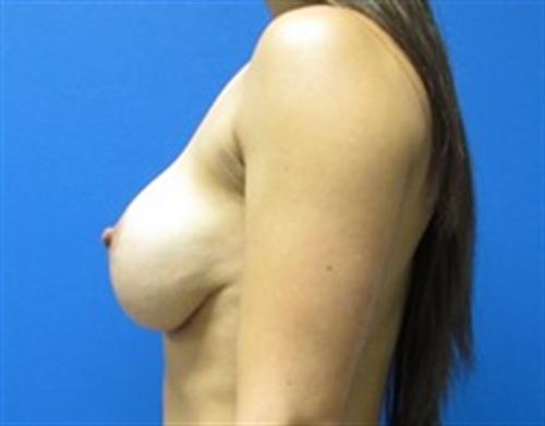 Breast Augmentation Before and After | SGK Plastic Surgery