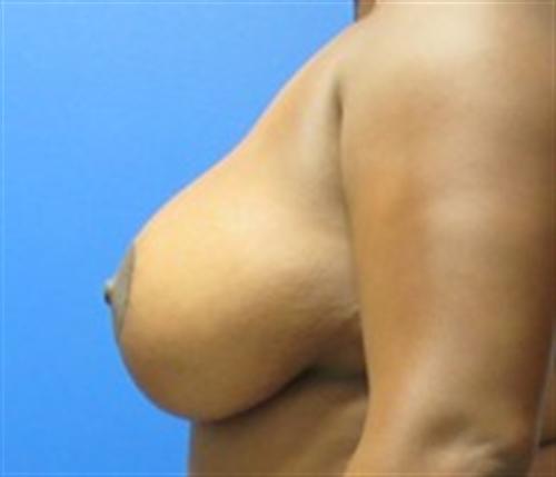 Breast Augmentation Before and After | SGK Plastic Surgery