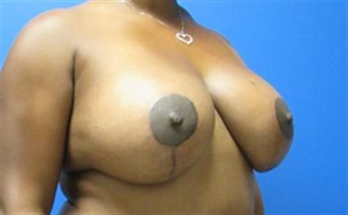 Breast Augmentation Before and After | SGK Plastic Surgery