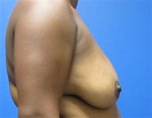 Breast Augmentation Before and After | SGK Plastic Surgery
