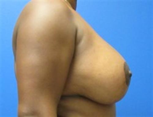 Breast Augmentation Before and After | SGK Plastic Surgery