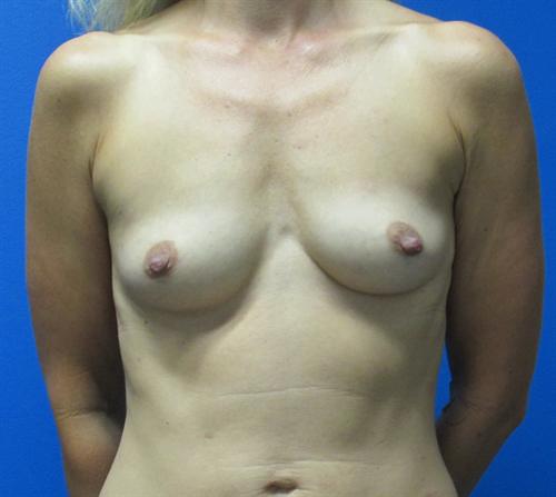 Breast Augmentation Before and After | SGK Plastic Surgery